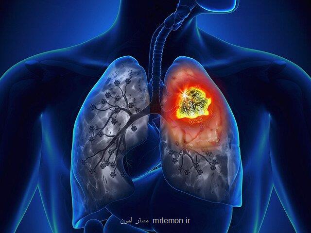كاهش مرگ ومیر ناشی از سرطان ریه با مدلهای جدید پیشبینی