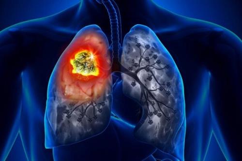 ارتباط آلودگی هوا با افزایش مبتلاشدن به سرطان ریه