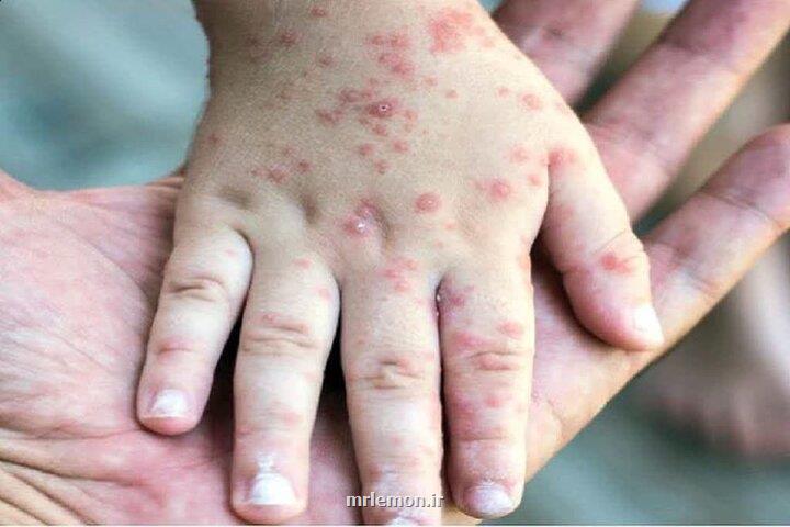 تست آنتی بادی ضد سرخک هیچ مبنای علمی ندارد