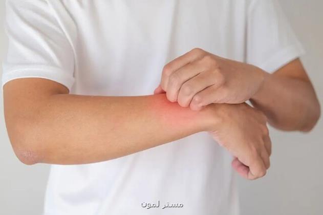 تغییر فصل، محرک اگزماست نه عامل ایجاد آن