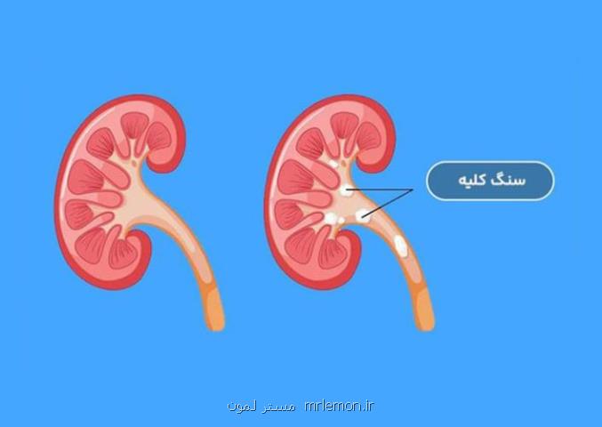 دفع سنگ کلیه قطعی