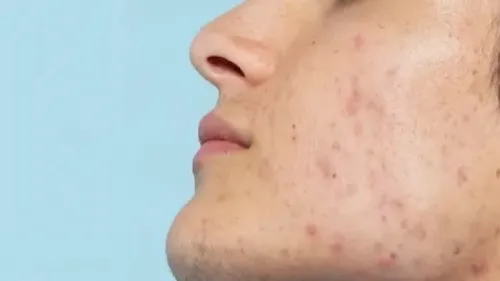 قوی ترین نسخه طب سنتی برای رویارویی با آکنه صورت به همراه فیلم