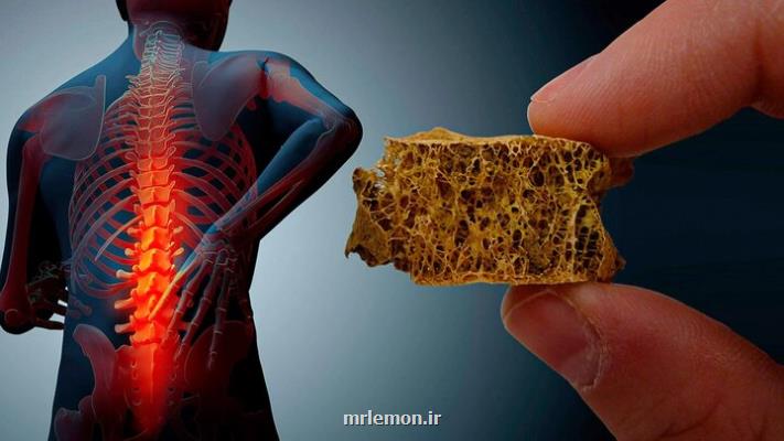 نیمی از زنان بالای ۵۰ سال کشور گرفتار پوکی استخوان هستند