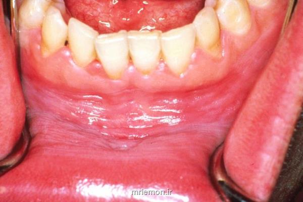 تولید چسب مخاطی كوركومین برای درمان ضایعات زخمی لیكن پلان دهانی